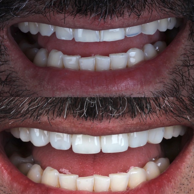 Facetas de Resina - Clínica DYVARE